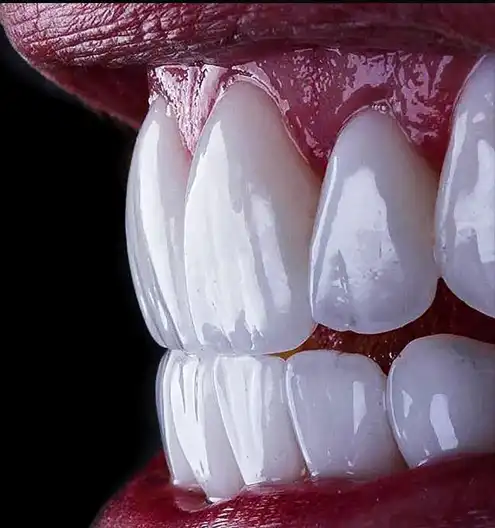 E-max lityum disilikat CAD/CAM restorasyon &ndash; Esnan Digital Lab