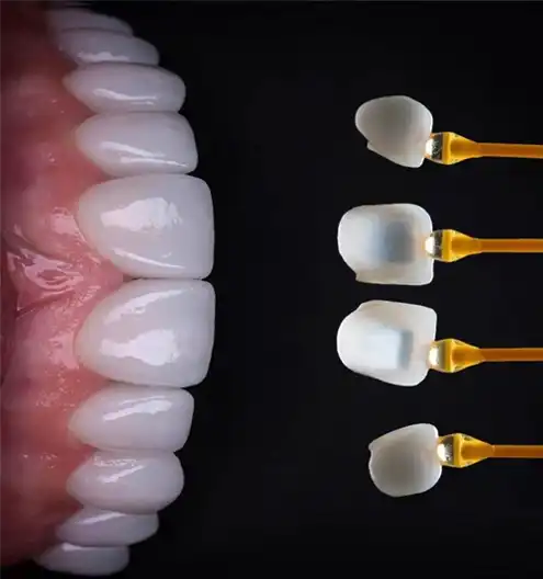 Dijital laminate veneer CAD/CAM tasarımı &ndash; Esnan Digital Lab